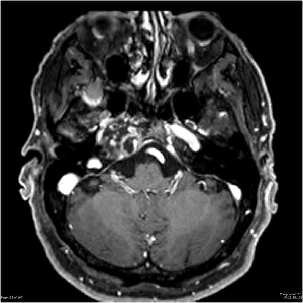 File:Chondrosarcoma of skull base- grade II (Radiopaedia 40948-43654 Axial T1 C+ 13).jpg