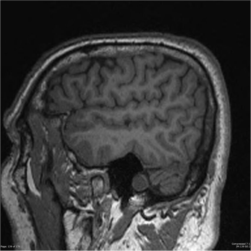 Chondrosarcoma of skull base- grade II (Radiopaedia 40948-43654 Sagittal T1 62).jpg