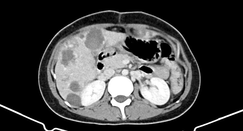 File:Choriocarcinoma liver metastases (Radiopaedia 74768-85766 A 88).jpg