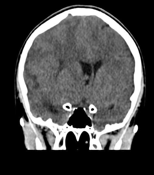 File:Choroid plexus carcinoma (Radiopaedia 91013-108552 Coronal non-contrast 34).jpg