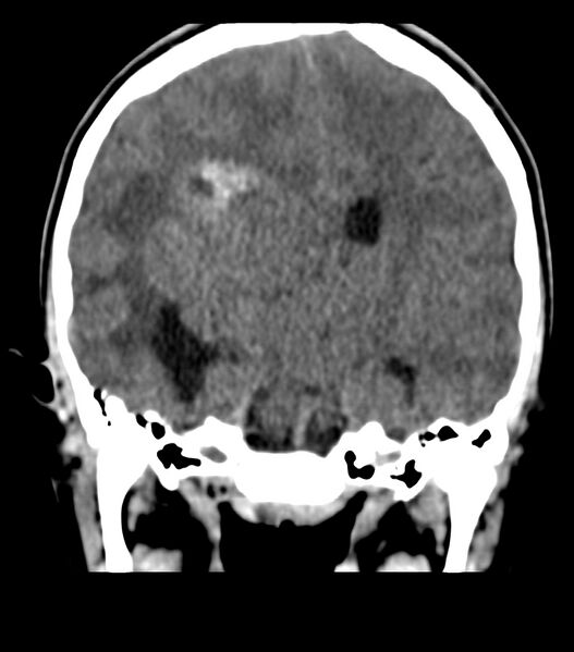 File:Choroid plexus carcinoma (Radiopaedia 91013-108552 Coronal non-contrast 45).jpg