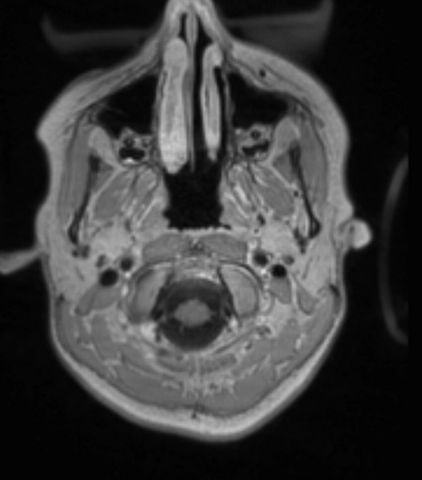 Choroid plexus carcinoma (Radiopaedia 91013-108553 Axial T1 C+ 70).jpg