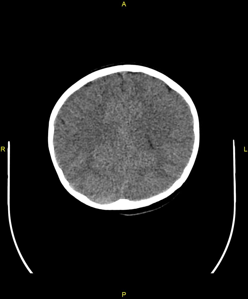 Choroidal fissure cyst (Radiopaedia 89481-106465 Axial non-contrast 83).jpg