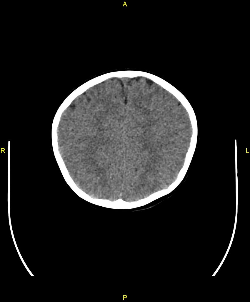 Choroidal fissure cyst (Radiopaedia 89481-106465 Axial non-contrast 92).jpg
