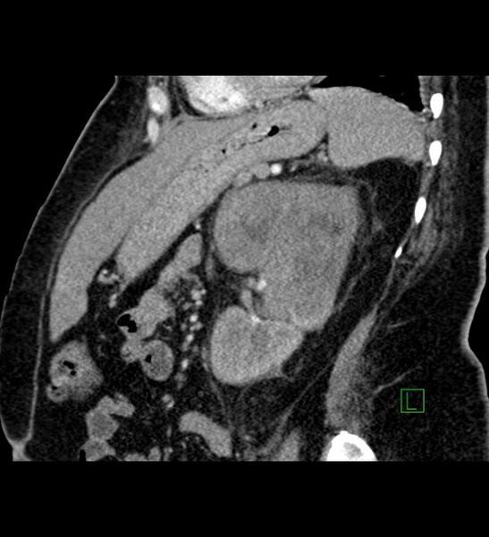 File:Chromophobe renal cell carcinoma (Radiopaedia 84239-99519 D 42).jpg