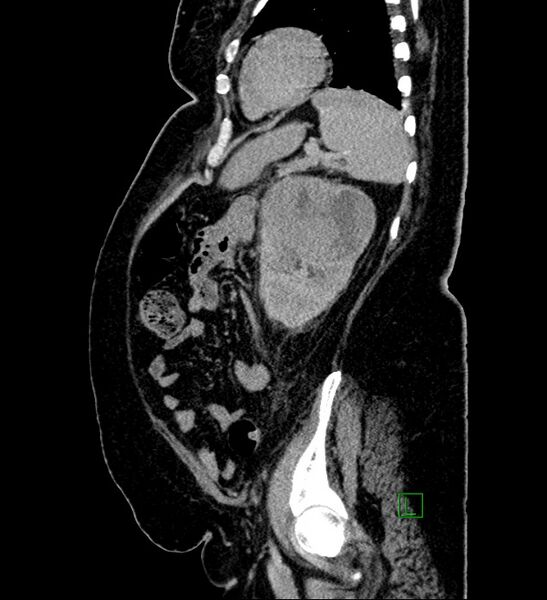 File:Chromophobe renal cell carcinoma (Radiopaedia 84239-99519 G 32).jpg