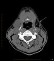 Chronic Submandibular sialolithiasis (Radiopaedia 16880-16606 Axial non-contrast 20).jpg