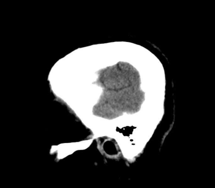 File:Chronic bilateral occipital lobe infarcts (Radiopaedia 31276-31996 C 6).jpg