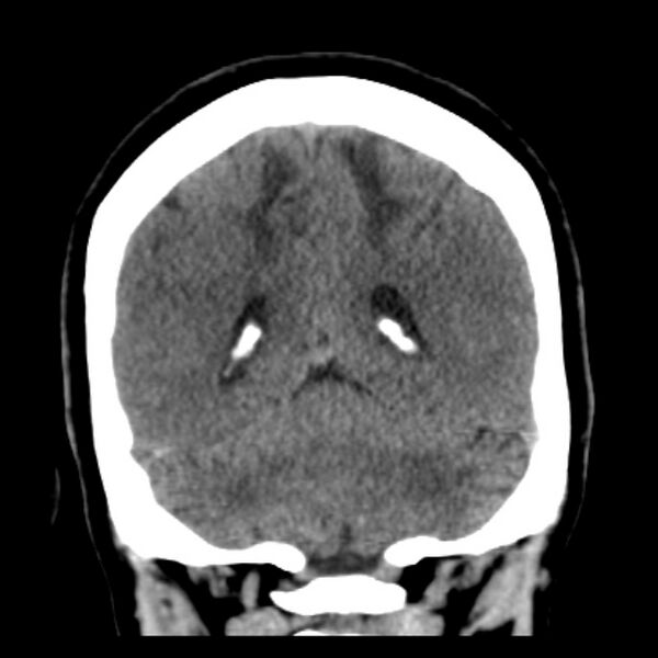 File:Chronic bilateral occipital lobe infarcts (Radiopaedia 31276-31996 Coronal non-contrast 35).jpg