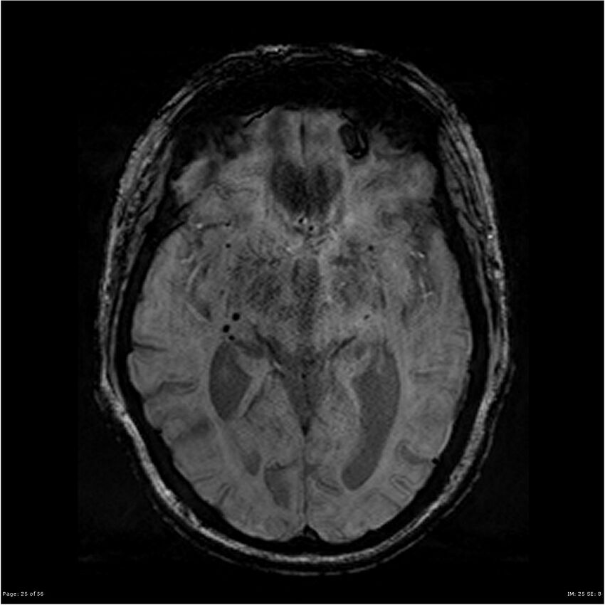 Chronic hypertensive encephalopathy (Radiopaedia 25764-25918 Axial SWI 25).jpg