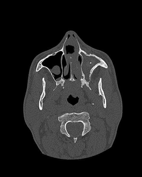 File:Chronic maxillary sinusitis caused by a foreign body (Radiopaedia 58521-65676 Axial bone window 96).jpg