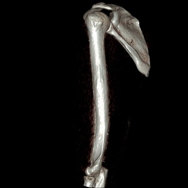 File:Chronic osteomyelitis (Radiopaedia 67597-76998 3D Volume Rendering 6).jpg