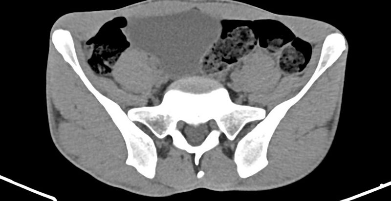 File:Chronic osteomyelitis (with sequestrum) (Radiopaedia 74813-85822 D 3).jpg