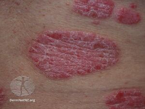 Chronic plaque psoriasis (DermNet NZ chronic-plaque-psoriasis-019).jpg