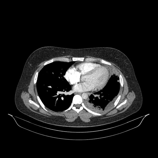 File:Chronic thromboembolic pulmonary hypertension (CTEPH) (Radiopaedia 74597-85532 Axial C+ CTPA 70).jpg