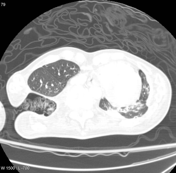 File:Clagett thoracotomy (Radiopaedia 8568-9403 Axial lung window 6).jpg