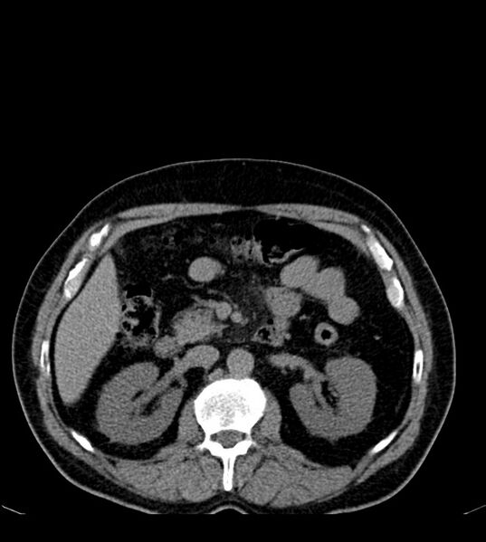 File:Clear cell renal cell carcinoma (Radiopaedia 85006-100539 Axial non-contrast 35).jpg