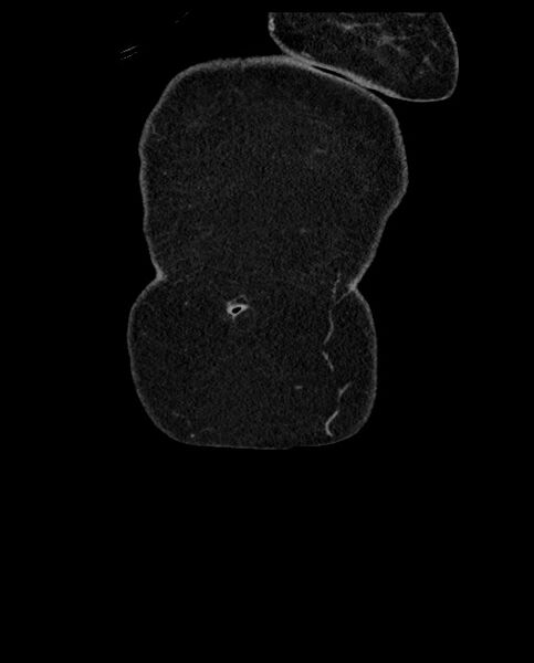 File:Closed loop small bowel obstruction - adhesions (Radiopaedia 59269-66611 B 8).jpg