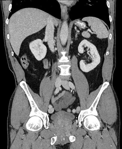 File:Closed loop small bowel obstruction - internal hernia (Radiopaedia 57806-64778 A 64).jpg