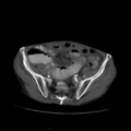 Closed loop small intestinal obstruction (Radiopaedia 16156-15835 Axial non-contrast 3).png