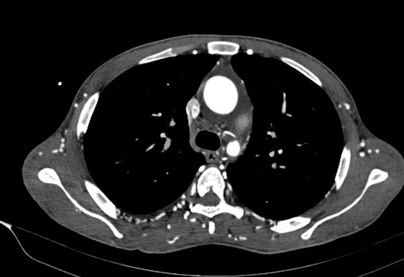 File:Coarctation of aorta with aortic valve stenosis (Radiopaedia 70463-80574 A 54).jpg