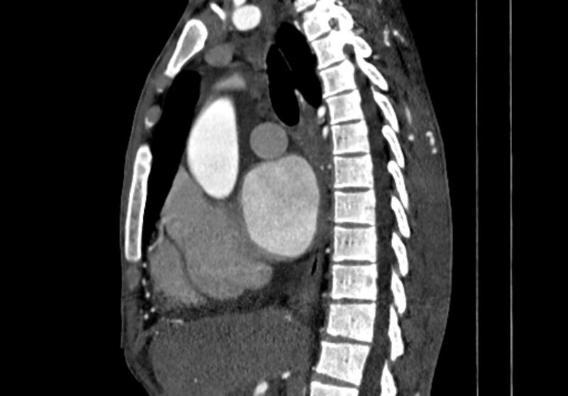 File:Coarctation of aorta with aortic valve stenosis (Radiopaedia 70463-80574 B 43).jpg