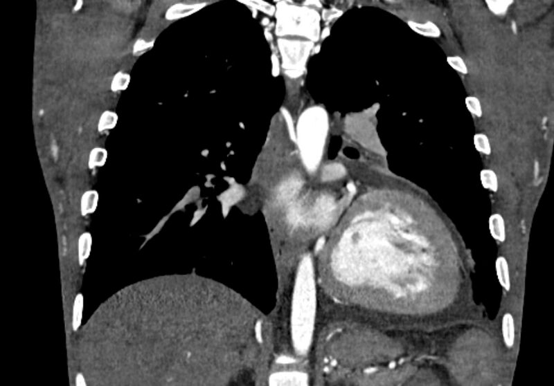 File:Coarctation of aorta with aortic valve stenosis (Radiopaedia 70463-80574 C 154).jpg