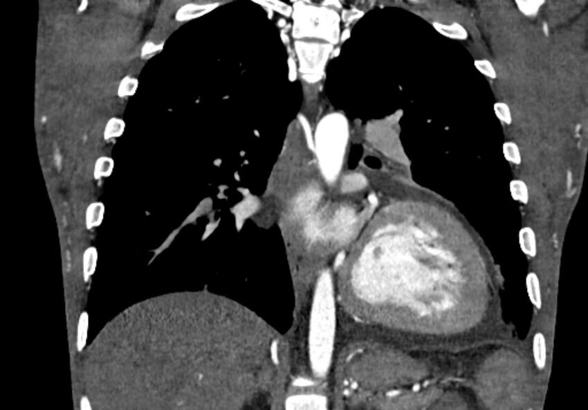 Coarctation of aorta with aortic valve stenosis (Radiopaedia 70463-80574 C 154).jpg