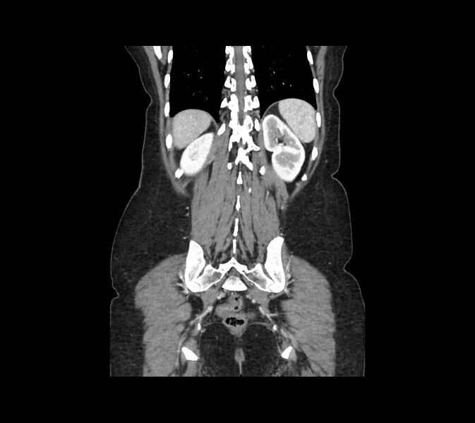 File:Cocoon abdomen with possible tubo-ovarian abscess (Radiopaedia 46235-50636 B 43).jpg