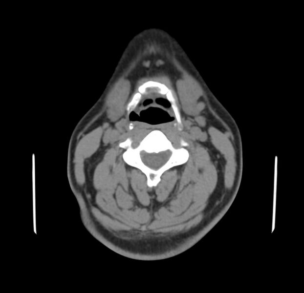 File:Colloid cyst of thyroid (Radiopaedia 22897-22923 Axial non-contrast 25).jpg