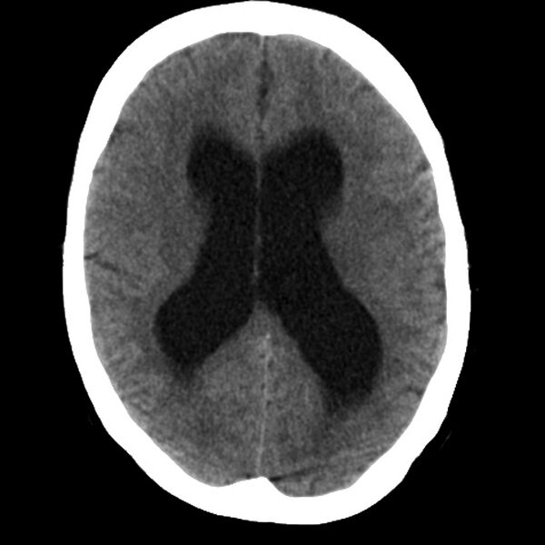 File:Colloid cyst with hydrocephalus (Radiopaedia 9373-10064 Axial non-contrast 12).jpg