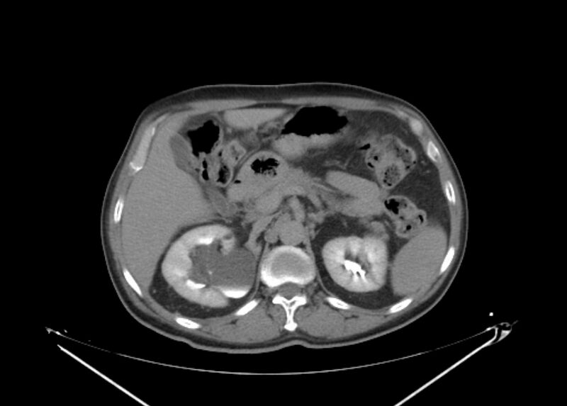 File:Colon cancer mimicking renal cell carcinoma (Radiopaedia 28986-29335 Axial C+ delayed 23).jpg