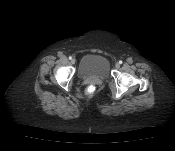 File:Colonic diverticulosis (Radiopaedia 22934-22957 A 71).jpg