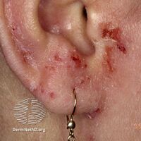 Eczema on ear