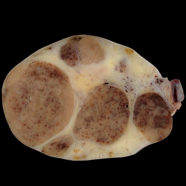 File:Luteoma of pregnancy (gross pathology) (Radiopaedia 77664).jpeg
