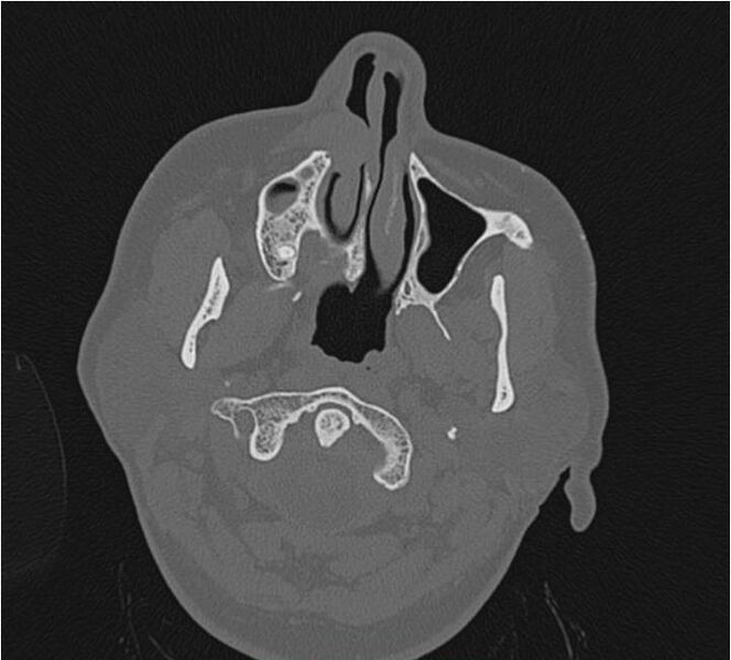 File:Nasolabial cyst (Radiopaedia 25322-25580 Axial bone window 6).jpg