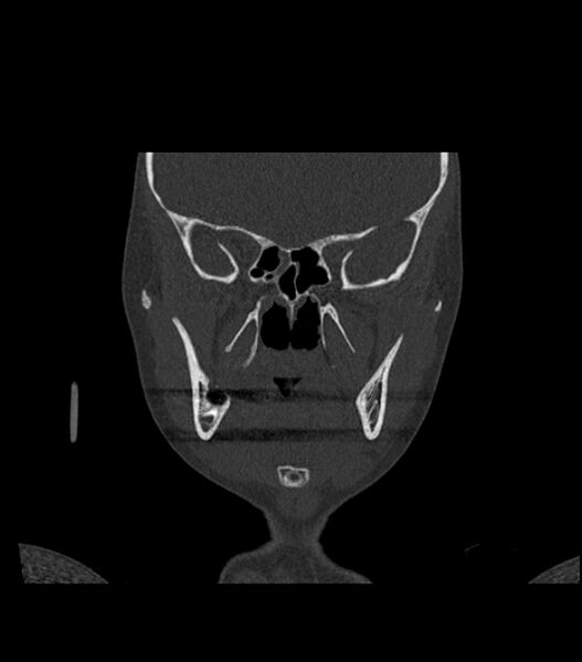 File:Nasoorbitoethmoid fracture (Radiopaedia 90044-107205 Coronal bone window 66).jpg