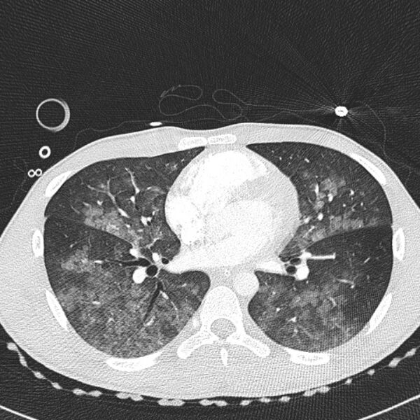 File:Near drowning (pulmonary edema) (Radiopaedia 24685-24958 lung window 38).jpg