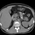 Necrotizing pancreatitis with acute necrotic collection (Radiopaedia 14470-14417 Axial non-contrast 12).jpg