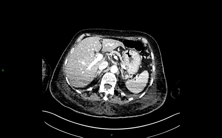 Neo-terminal ileal stricture (Crohn disease) (Radiopaedia 33790-34948 A 106).jpg