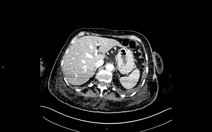 Neo-terminal ileal stricture (Crohn disease) (Radiopaedia 33790-34948 A 91).jpg