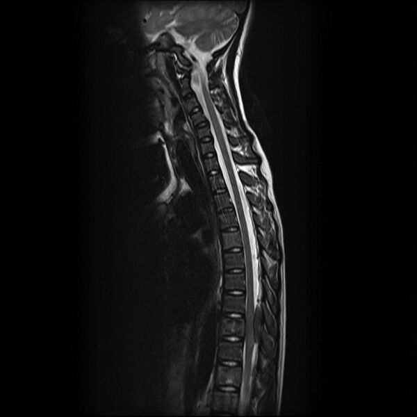 File:Neuroblastoma (Radiopaedia 5960-7489 Sagittal T2 1).jpg