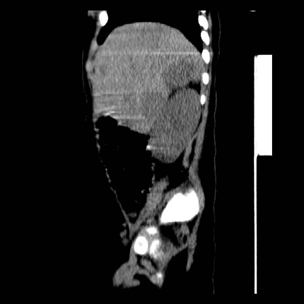 File:Neuroblastoma with skull metastases (Radiopaedia 30326-30960 B 11).jpg