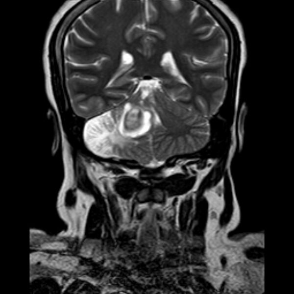 File:Neurofibromatosis type 2 (Radiopaedia 67470-76871 Coronal T2 16).jpg
