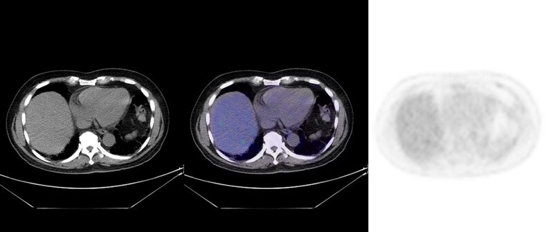 File:Non-Hodgkin lymphoma involving seminal vesicles with development of interstitial pneumonitis during Rituximab therapy (Radiopaedia 32703-33752 ax CT Fus PET 28).jpg