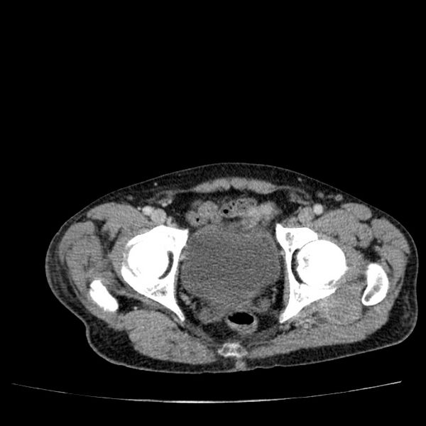 File:Non small-cell lung cancer (Radiopaedia 24467-24769 C+ delayed 113).jpg