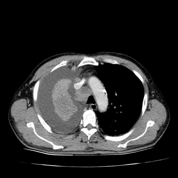 File:Non small-cell lung cancer (Radiopaedia 24467-24769 C+ delayed 20).jpg