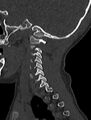 Normal CT cervical spine - pediatric (Radiopaedia 52549-58462 Sagittal bone window 38).jpg