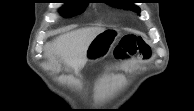 File:Normal CT intravenous cholangiogram (Radiopaedia 38199-40208 Coronal IVC 7).png