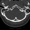 Normal CT of the cervical spine (Radiopaedia 53322-59305 Axial bone window 29).jpg